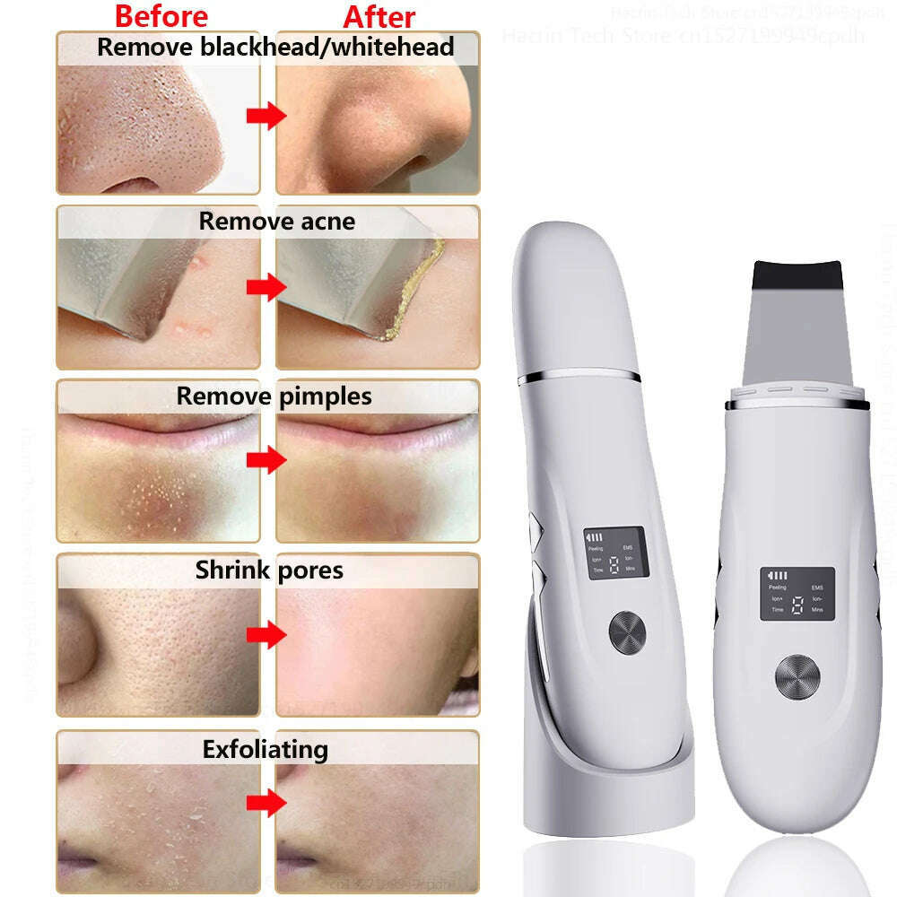 Ultrasonic Peeling Remover Blackhead Facial Skin Scrubber Facial Shovel Deep Cleaning Face Lifting Removal Pore Acne EMS Lift - KIMLUD